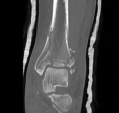 Tibial plafond medial plate 1